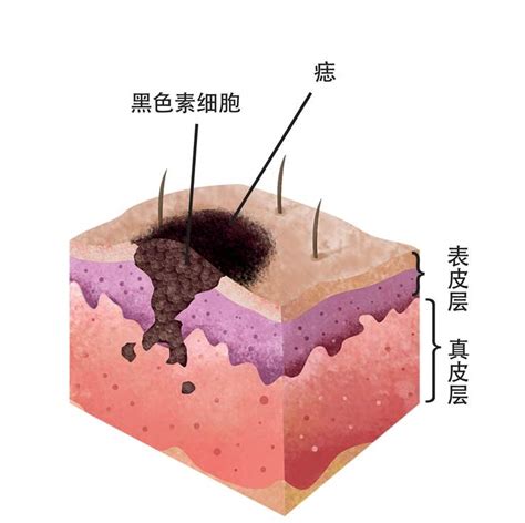 痣的形成原因